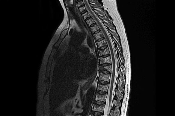 Projevy hrudní osteochondózy na obrazu MRI
