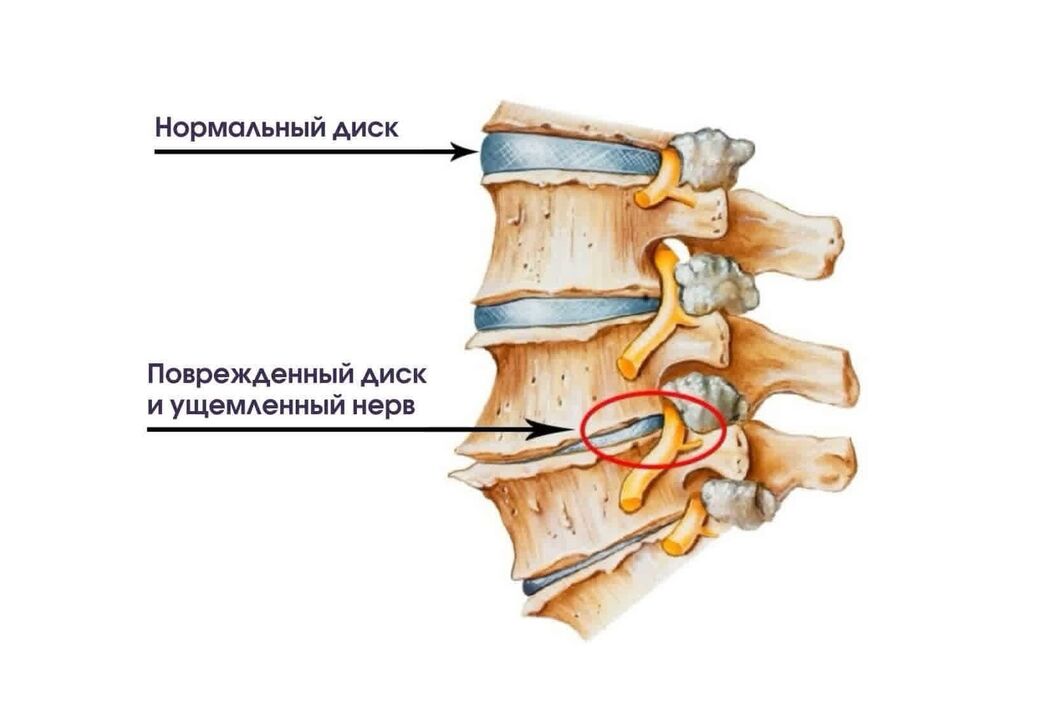 Příznaky osteochondózy děložního čípku