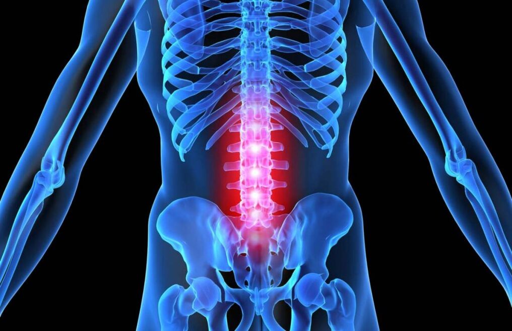 Osteochondrosis bederní páteře