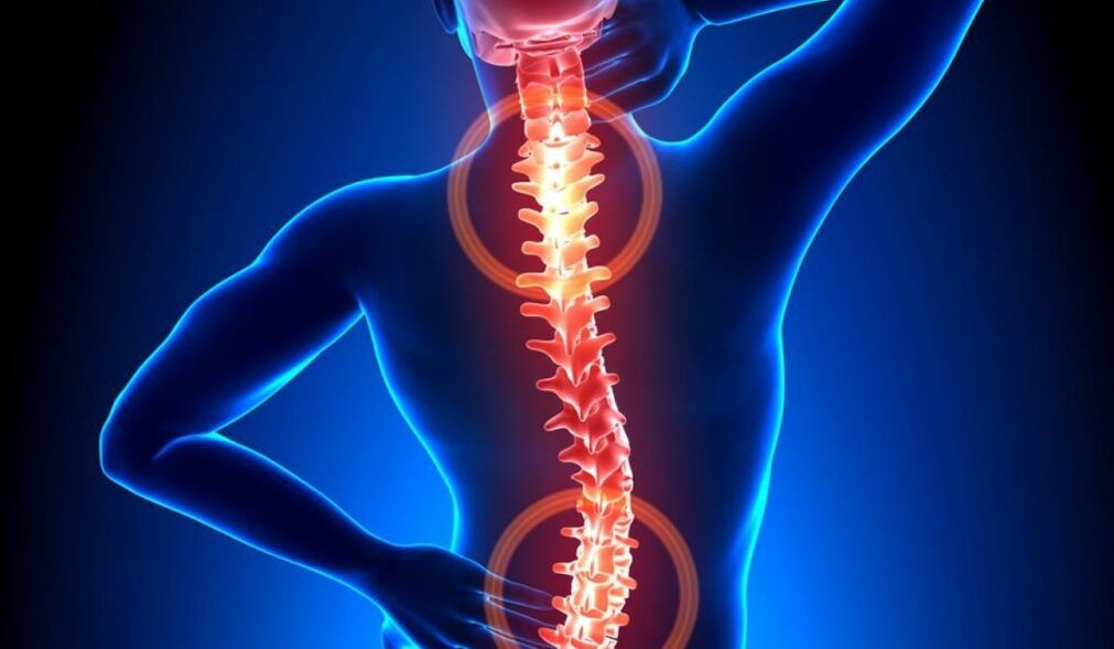 spinální osteochondróza