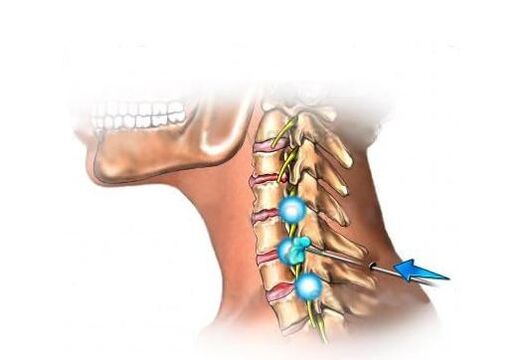 léčba cervikální osteochondrózy